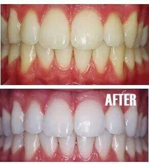 Changes after teeth whitening